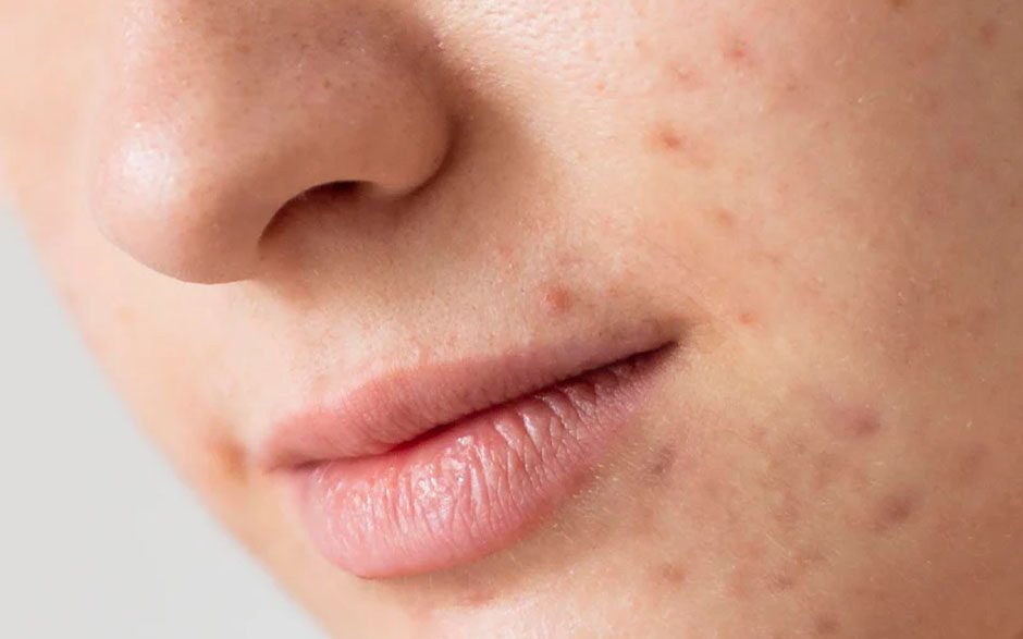 clearing acne on sensitive skin